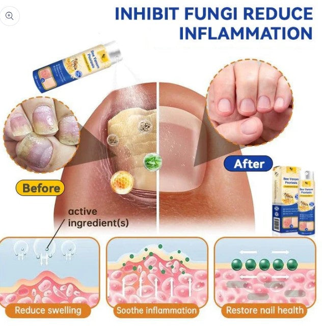 Spray contre le psoriasis LOVILDS™ PsoriaHeal