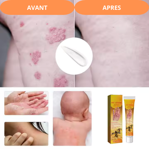 La crème de traitement du psoriasis au venin d'abeille OVILDS®